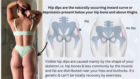 Hip Dips - Emedicodiary