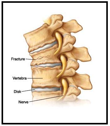 Vertebral Compression Fracture – NJ Spine Center