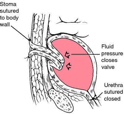 Cystostomy | definition of cystostomy by Medical dictionary