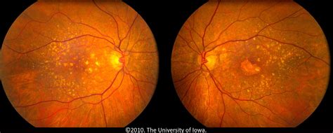 Age-related Macular Degeneration: Progression from Atrophic to ...