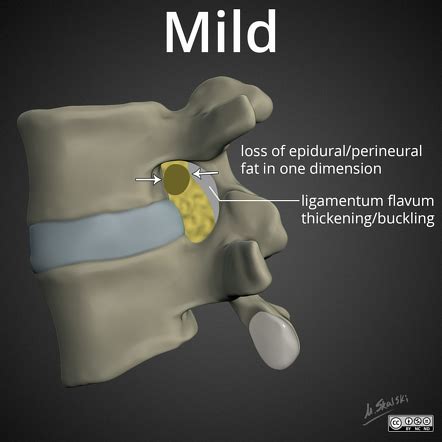 Lumbar Foraminal Stenosis Radiology Reference Article Radiopaedia Org | My XXX Hot Girl