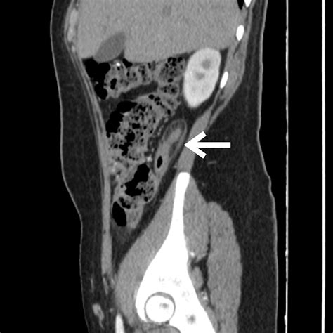 Retrocecal Appendicitis Post-blunt Abdominal Trauma: A Case Report | Cureus