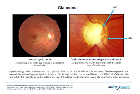 Glaucoma | PANCE EENT Content Blueprint - Smarty PANCE