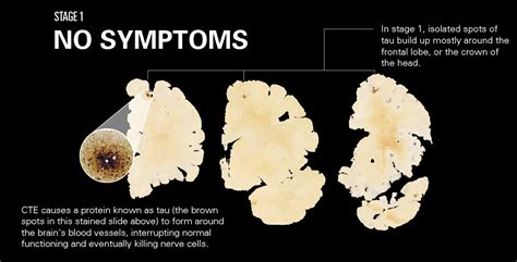 How CTE Affects the Brain | League of Denial: The NFL's Concussion ...