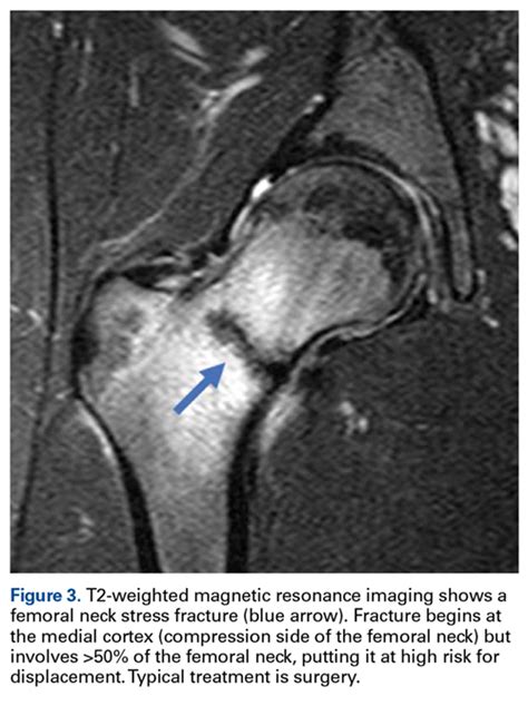 FEMORAL NECK STRESS FRACTURES – Agile Ortho