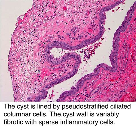 Pathology Outlines - Surgical ciliated cyst