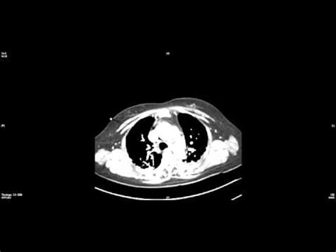 CT Aortogram - traumatic aortic dissection - YouTube