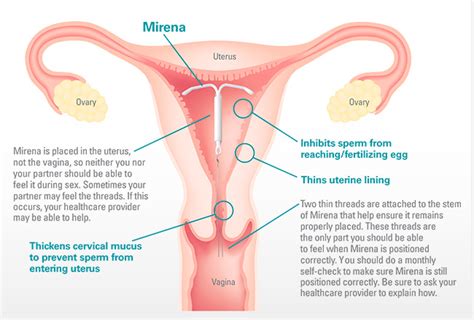 Mirena Intrauterine Device - EverythingYou Need To Know