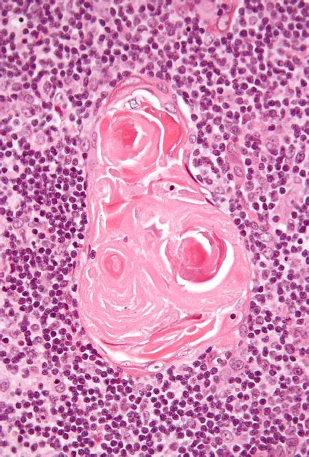 Thymus - Libre Pathology