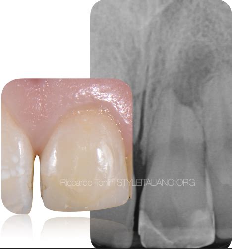 Endodontic treatment of an immature necrotic tooth - Style Italiano ...