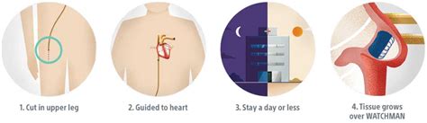 How The WATCHMAN Device Works