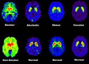 Brain positron emission tomography - Wikipedia