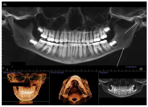 Utilize Panorex Radiographs