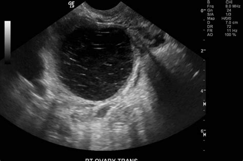 Hemorrhagic Cyst Ultrasound