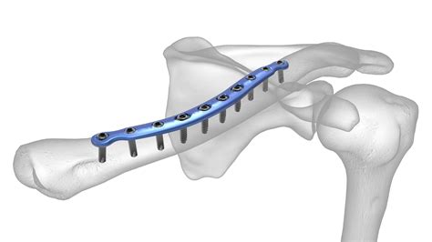 Midshaft Clavicle Plate | Acumed