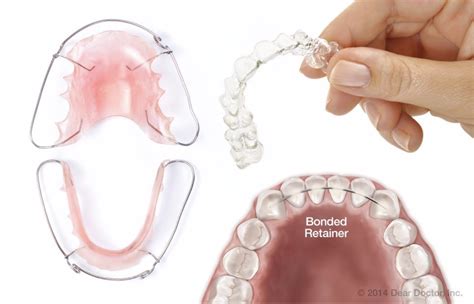 How to Properly Clean Orthodontic Retainers