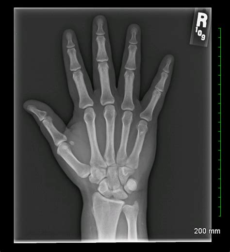 Archive Of Unremarkable Radiological Studies: Right Hand X-Ray - Stepwards