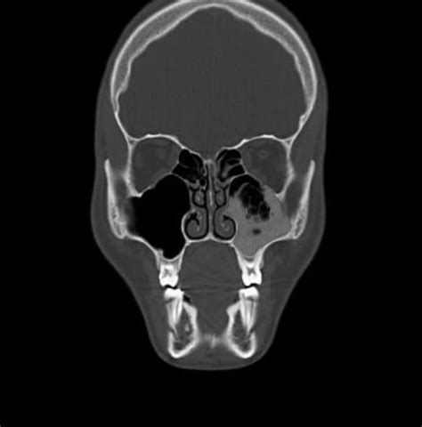 How to Read a CT Sinus Scan for the Layperson | Fauquier ENT Blog