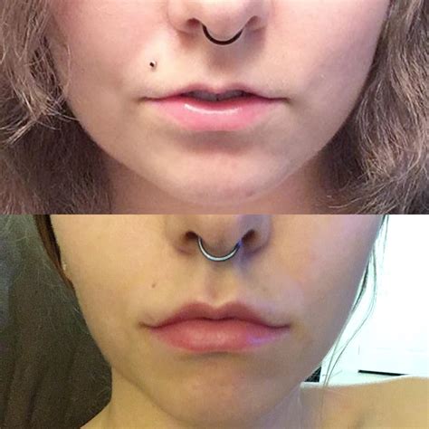 Lip fillers 2ml over 6 months. Plus a botox lip flip. Results after 2 weeks. : r/PlasticSurgery