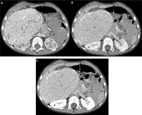 CT, showing a large liver right lobe mass (1) in the arterial ...