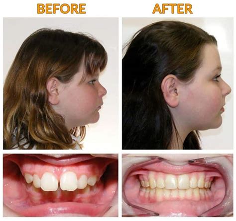 The Jawline Stretch: A Safe And Effective Treatment For An Overbite ...