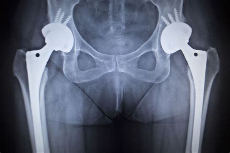 New Warning Issued for Stryker Hip Implants