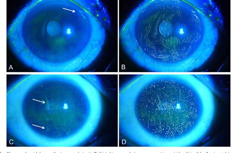 Corneal Staining Chart