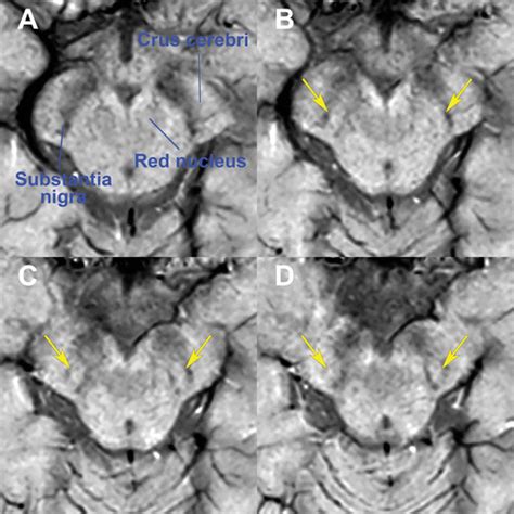 Imaging the Substantia Nigra in Parkinson Disease and Other ...