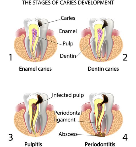 Top 105+ Pictures Stages Of Cavity With Pictures Sharp