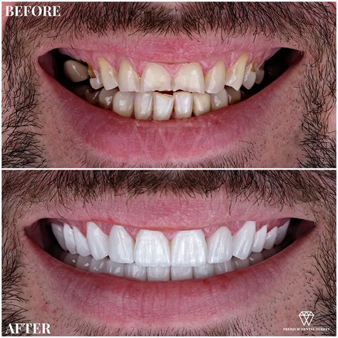 Veneers Turkey | Dental veneers, Teeth makeover, Veneers teeth