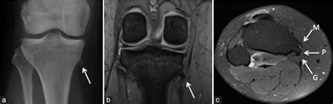 An assessment of the incidence and significance of pes anserine ...