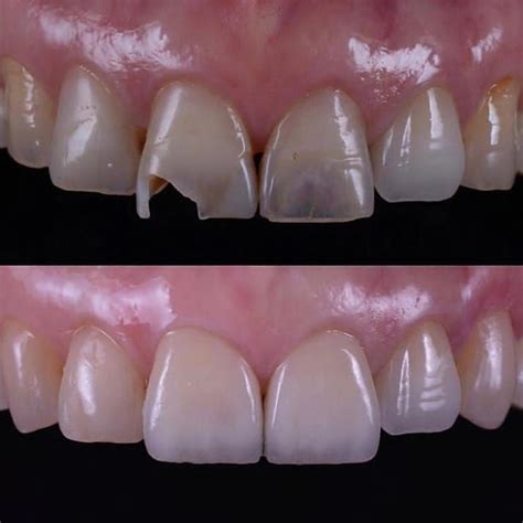 Composite veneers | Dental fillings, Dental implants cost, Restorative dentistry