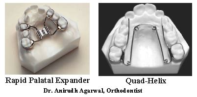 (#42) Does a Palatal Expander Interrupt Speech Therapy? - Speech Dynamics, Inc.