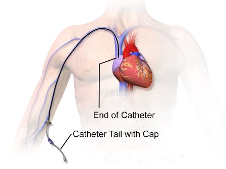 Picc Catheter