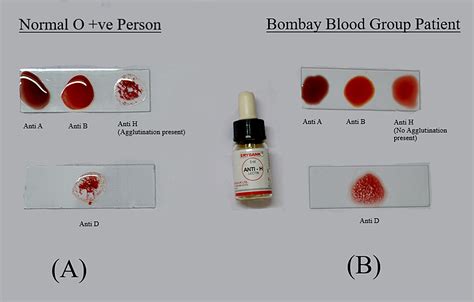 Cureus | Secondary Postpartum Hemorrhage Presenting With Bombay Blood ...