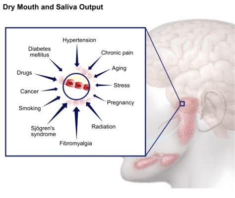 Xerostomia_Causes_from_Disease