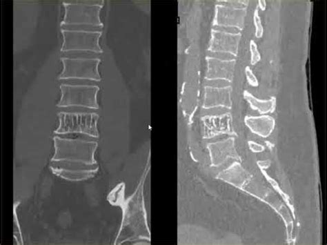 Vertebral Hemangioma