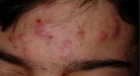 Nodular Acne Pictures, Causes, Treatment, Popping, Home Remedies for ...