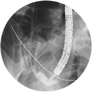 Stenting of the proximal colon in patients with malignant large bowel obstruction: techniques ...