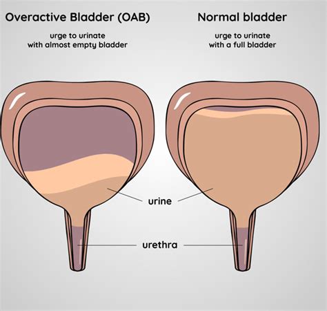 Overactive Bladder - Limitless