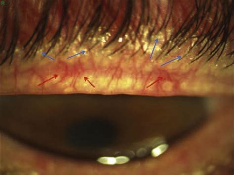 Anterior blepharitis of a mixed type of the upper eyelid. This shows a... | Download Scientific ...