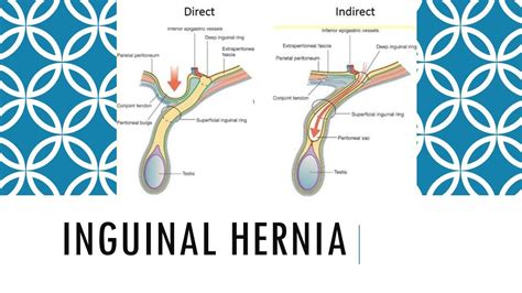 Direct Vs Indirect Inguinal Hernias Symptoms Causes And Treatment | The Best Porn Website