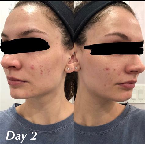 Three months of Tazorac and acne is worse - Prescription acne ...