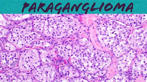 Paraganglioma (carotid body tumor) & Pheochromocytoma (explained in 5 minutes) video | KiKo XP