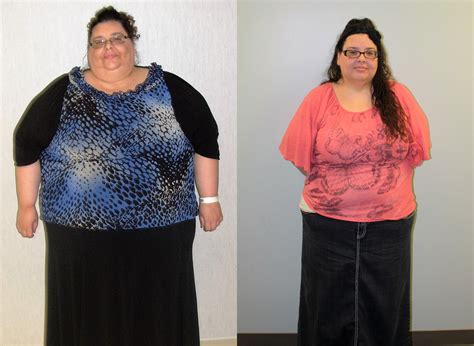 Gastric Bypass Surgery Before and After in St. Louis | St Louis Bariatrics