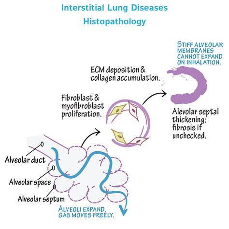 Pathology Glossary: Interstitial Lung Diseases | Draw It to Know It