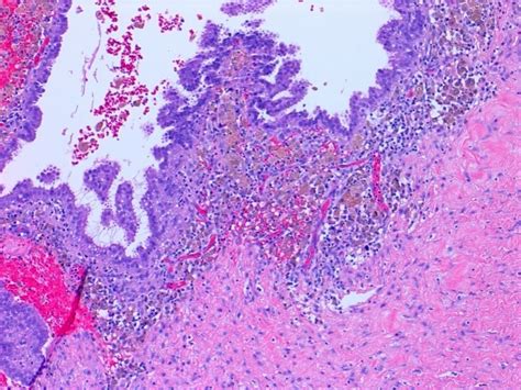 Pathology Outlines - Endometriosis