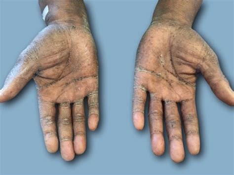 Keratosis punctata of the palmar creases in a 68-year-old African-American man | BMJ Case Reports