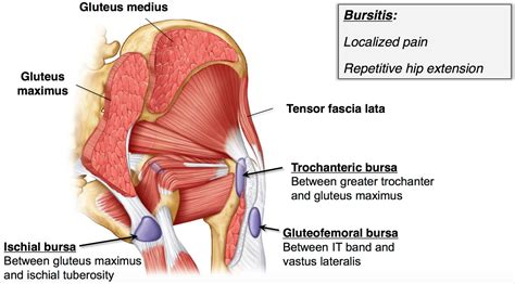 Bursitis - Hip, Trochanteric, Knee, Shoulder, Elbow - Causes & Treatment