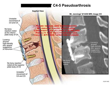 C4-5 Pseudoarthrosis